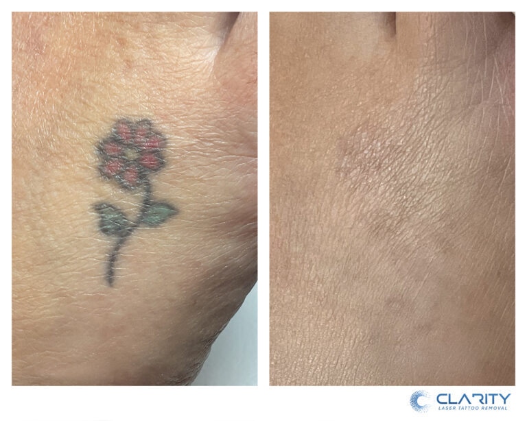 Red and green ink rose tattoo on the hand: before treatment, and after 8 laser treatments at Clarity, with the ink largely cleared