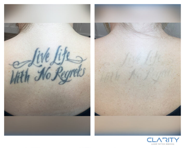 Large black ink script tattoo across the upper back: before treatment, and after 6 laser treatments at Clarity, significantly faded