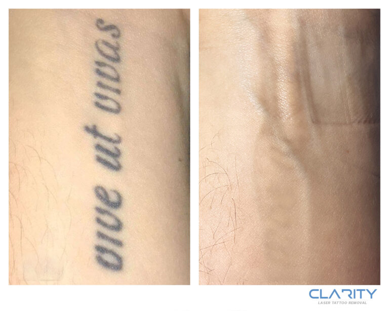 Black ink script tattoo on the wrist: before treatment, and after 7 laser treatments at Clarity, with the ink largely cleared